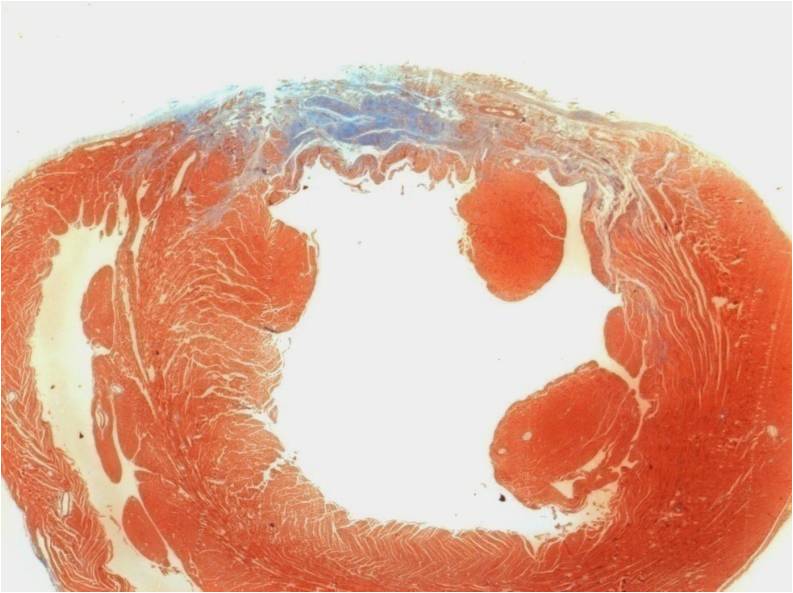 Cardiac myocytes injected into a myocardial infarction in a rat heart using a PEG-fibrinogen cell carrier; wall thickness after 30 days